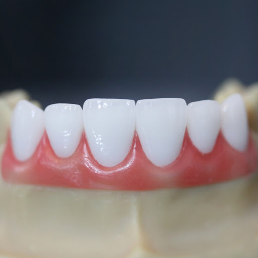 sứ lisi, mặt dán sứ lisi, sứ emax, mặt dán sứ emax